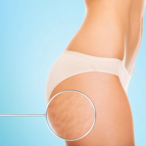 Cellulite: All About Those Butt Dimples