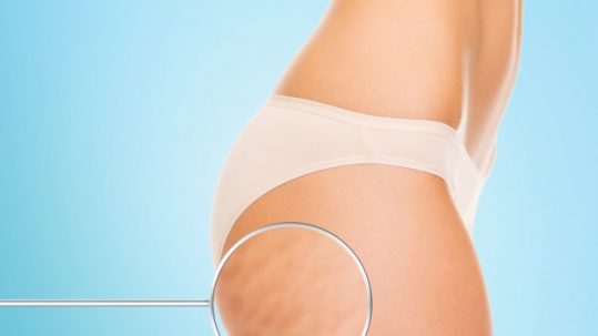 Cellulite: All About Those Butt Dimples